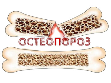 Лечение и профилактика остеопороза аппликаторами Ляпко